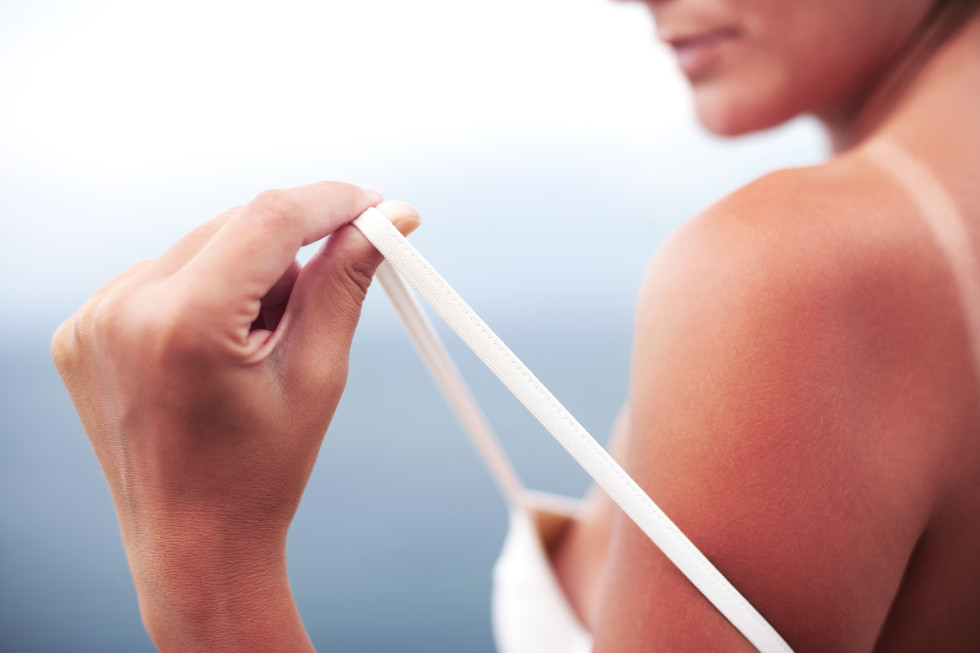 gegen sonnenbrand: die besten hauspraktiken